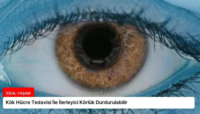 Kök Hücre Tedavisi İle İlerleyici Körlük Durdurulabilir