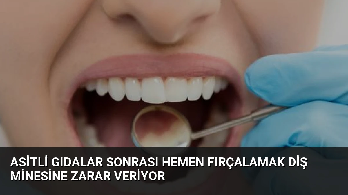 Asitli Gıdalar Sonrası Hemen Fırçalamak Diş Minesine Zarar Veriyor