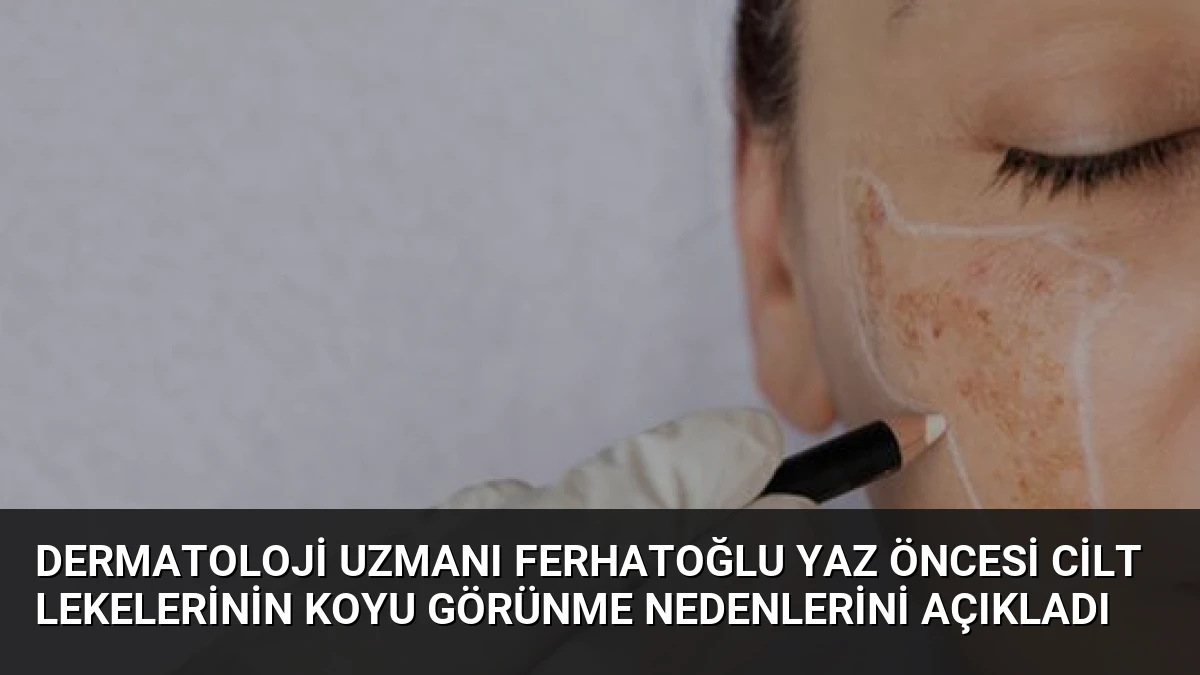 Dermatoloji Uzmanı Ferhatoğlu Yaz Öncesi Cilt Lekelerinin Koyu Görünme Nedenlerini Açıkladı