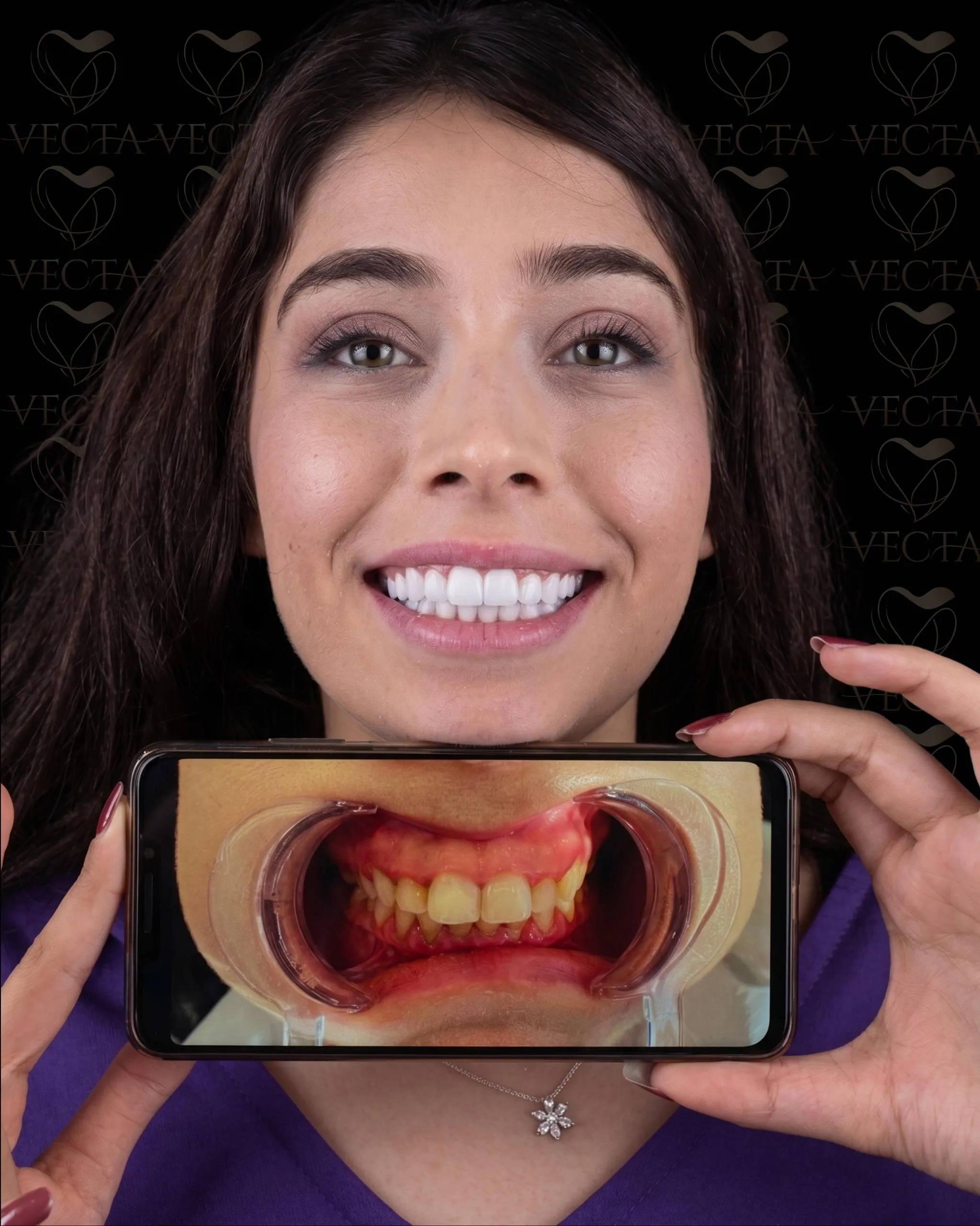 All-on-4 Tekniğiyle Aynı Günde Yeni Dişler: Vecta Dental Clinic