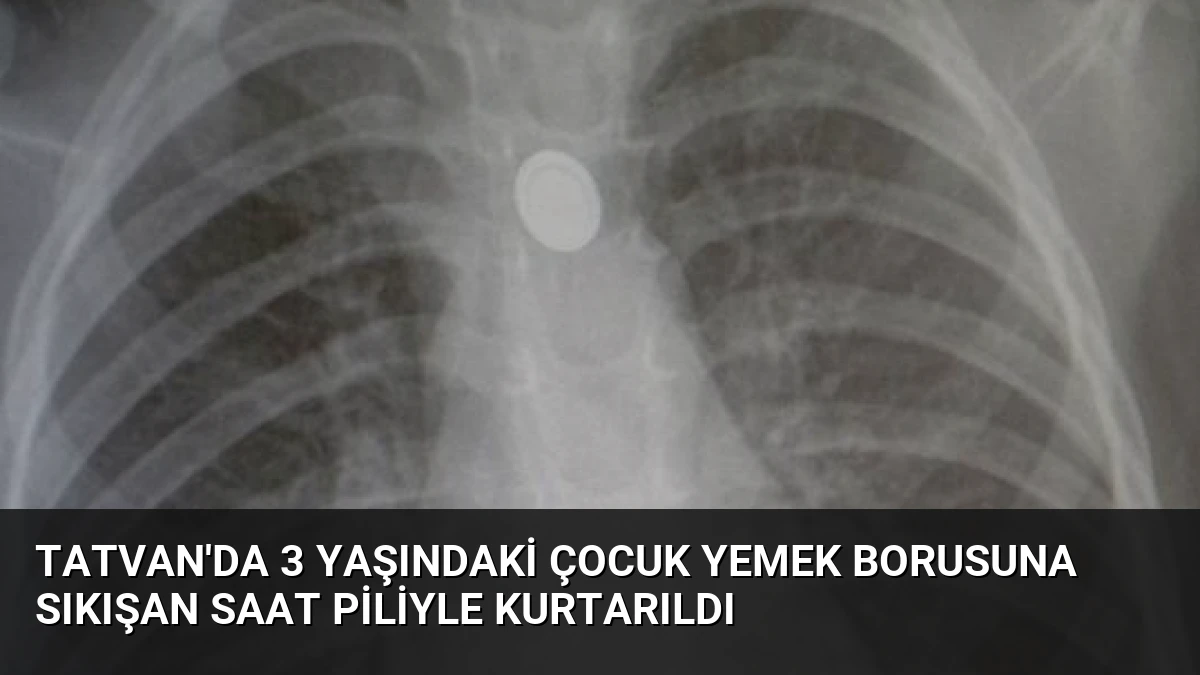 Tatvan’da 3 Yaşındaki Çocuk Yemek Borusuna Sıkışan Saat Piliyle Kurtarıldı