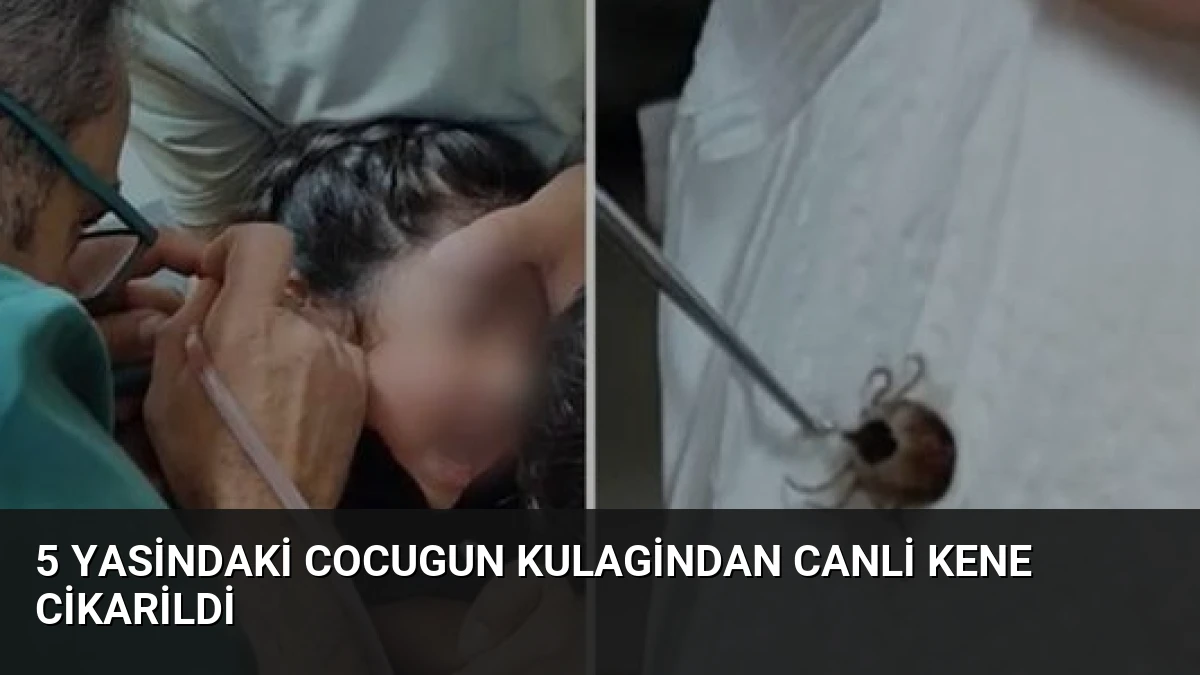 5 Yasindaki Cocugun Kulagindan Canli Kene Cikarildi