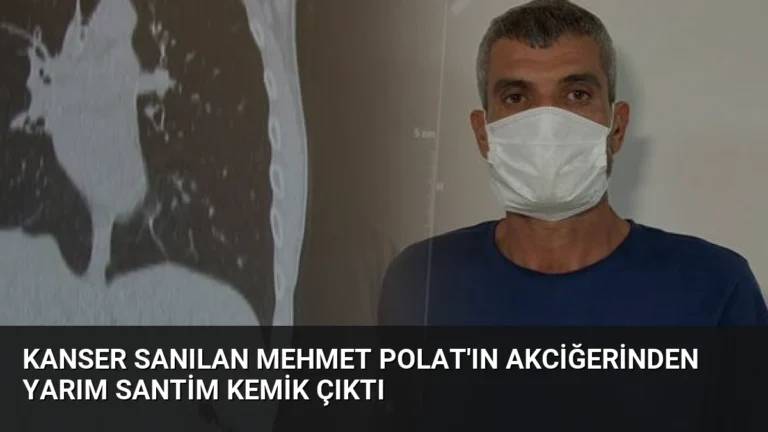 Kanser Sanılan Mehmet Polat’ın Akciğerinden Yarım Santim Kemik Çıktı