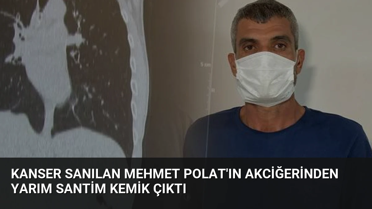 Kanser Sanılan Mehmet Polat’ın Akciğerinden Yarım Santim Kemik Çıktı