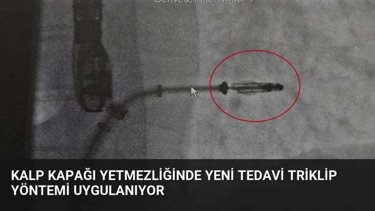 Kalp Kapağı Yetmezliğinde Yeni Tedavi Triklip Yöntemi Uygulanıyor
