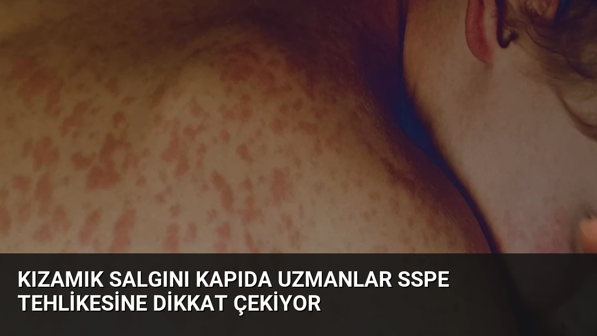 Kızamık Salgını Kapıda Uzmanlar SSPE Tehlikesine Dikkat Çekiyor